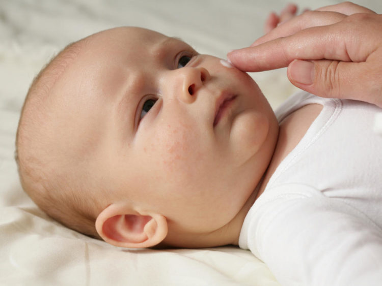 Trẻ em trẻ sơ sinh bị viêm da mụn mủ cần làm gì