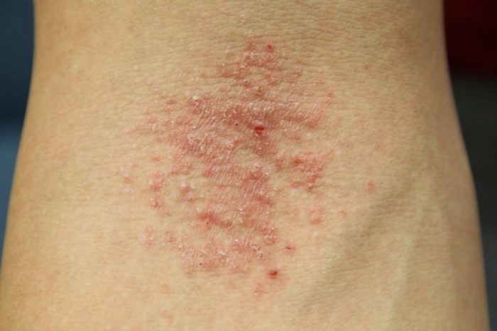 Bệnh Eczema là bệnh gì? Nguyên nhân và cách trị bệnh