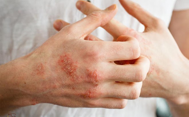 thuốc chữa bệnh eczema bằng thuốc nam