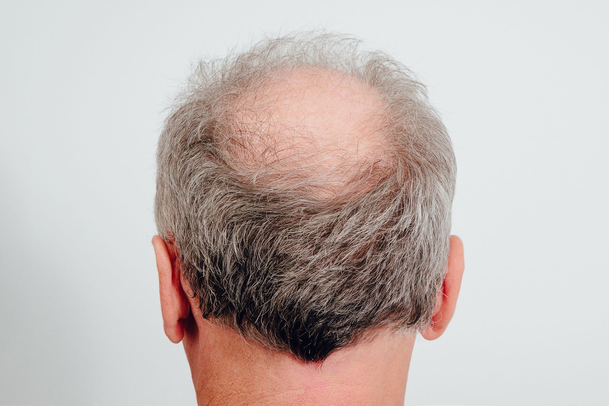 Nguyên nhân gây hói đầu ở nam giới là gì Có cách nào điều trị không
