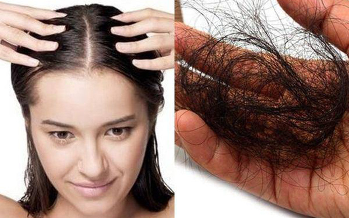 Bệnh rụng tóc mảng là gì Khắc phục như thế nào