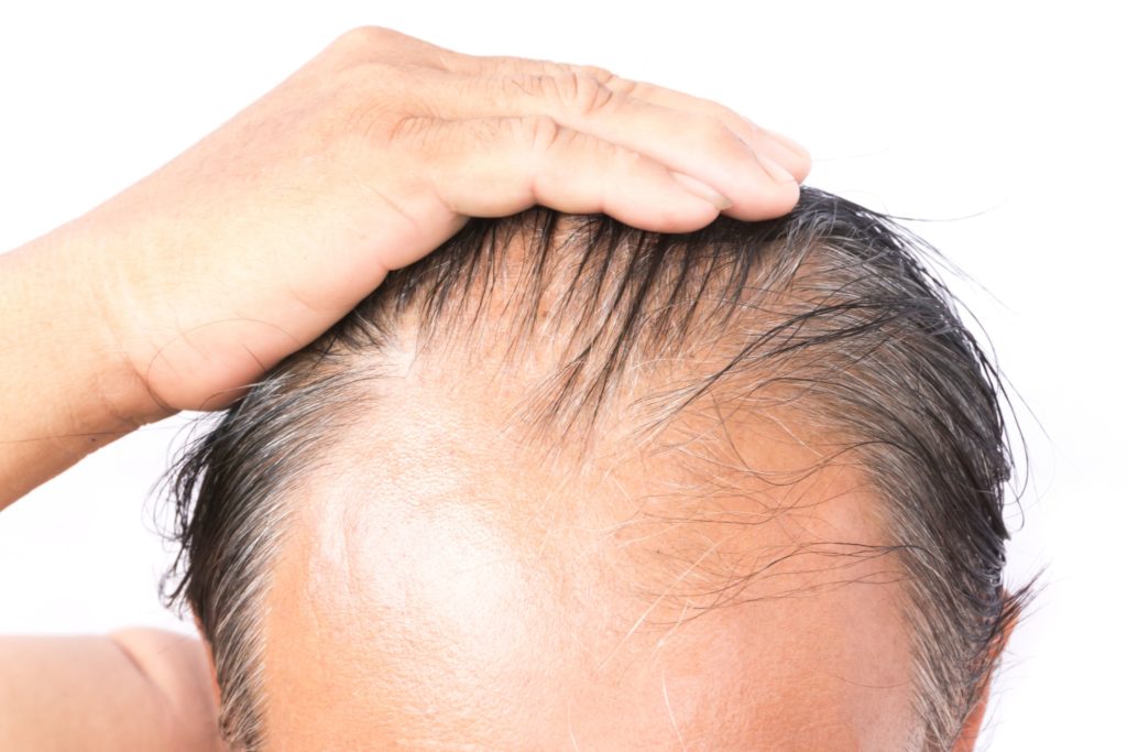 Minoxidil uống liều thấp an toàn cho bệnh rụng tóc • Khoa Da Liễu Thẩm Mỹ  Da - Bệnh viện Đại Học Y Dược TPHCM