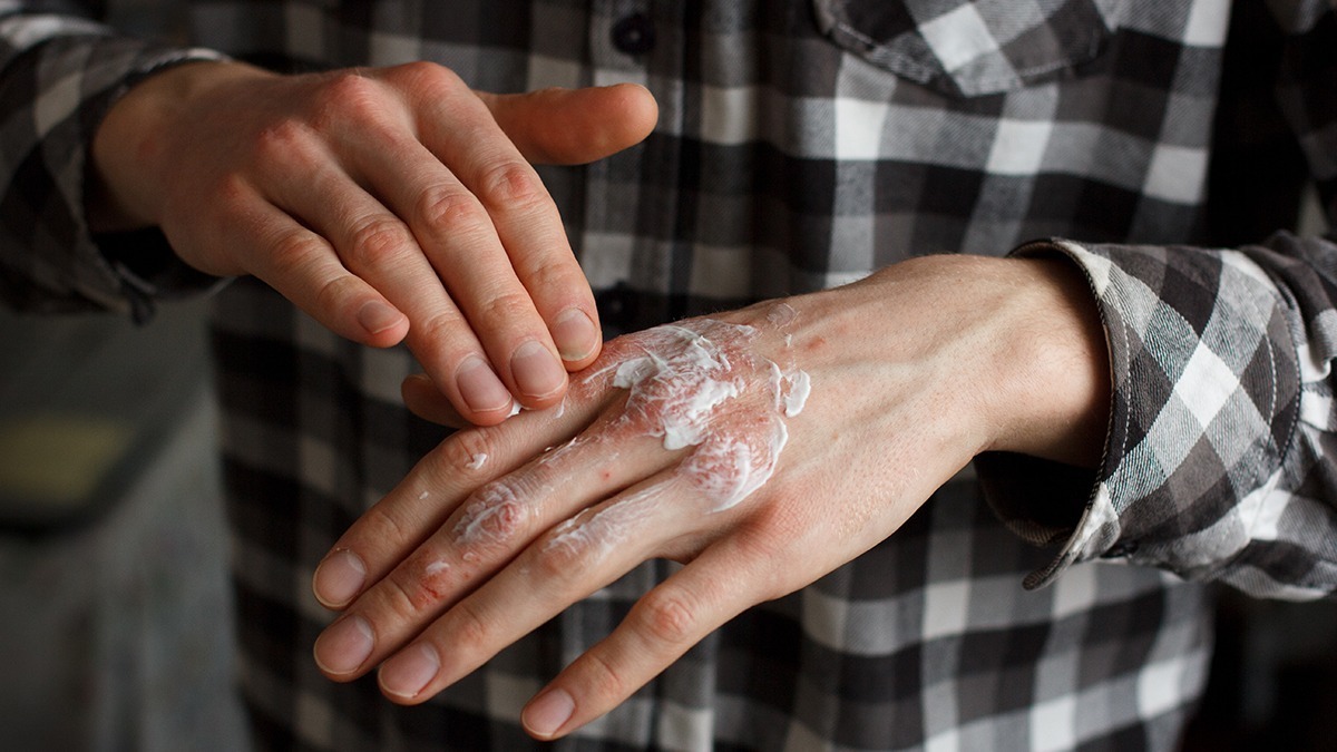 Vì sao bệnh vảy nến phát triển mạnh mùa đông?