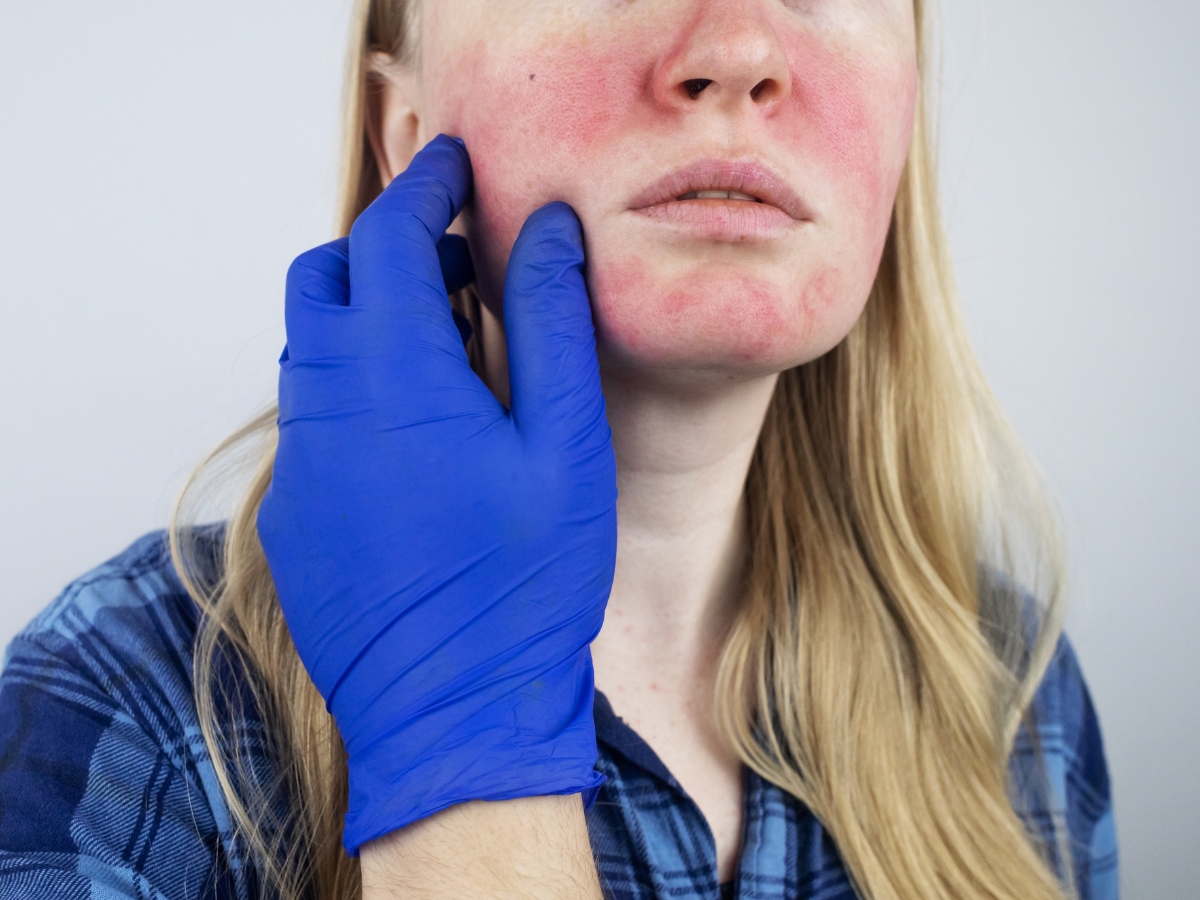 Mũi đỏ: Nguyên nhân và cách điều trị mũi đỏ hiệu quả