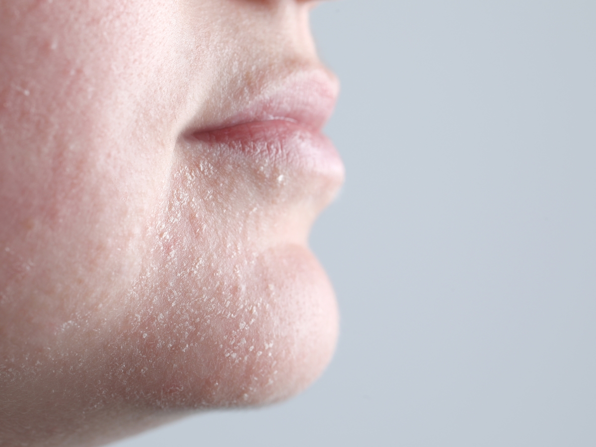 Mũi đỏ: Nguyên nhân và cách điều trị mũi đỏ hiệu quả