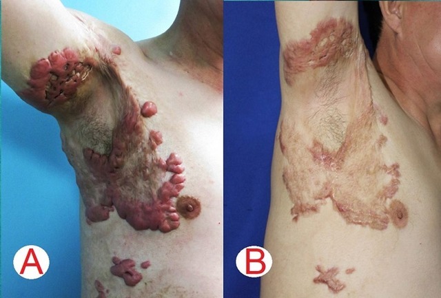 Bệnh nhân nam 46 tuổi với vết sẹo lồi do bỏng 2 năm (hình A) và kết quả sau 3 buổi điều trị laser (hình B), chưa ghi nhận tái phát sau 12 tháng