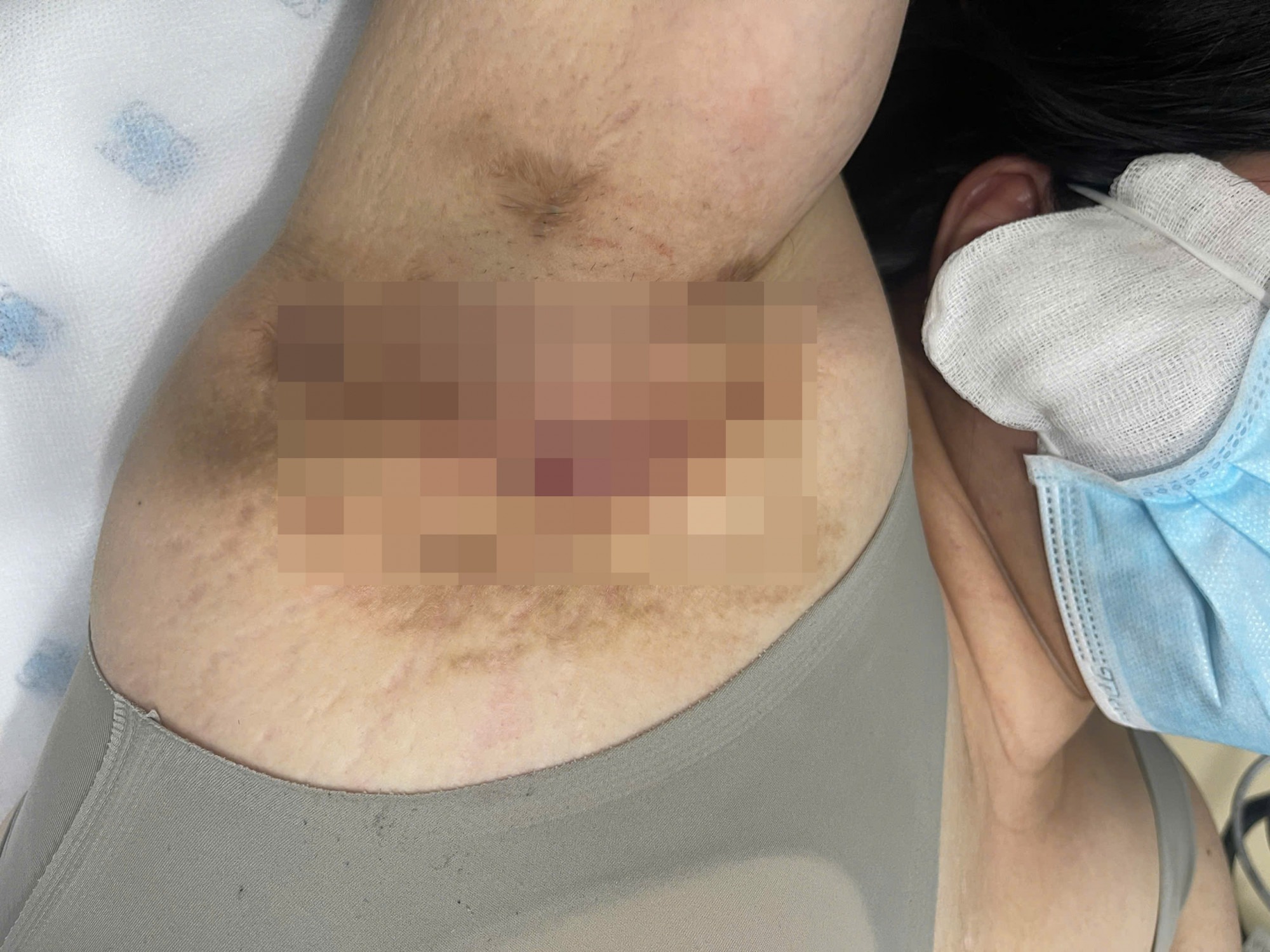 Bệnh nhân đã chấm dứt được nỗi khổ sở suốt 9 năm bị u tuyến mồ hôi mưng mủ - Ảnh: T. Q. H.