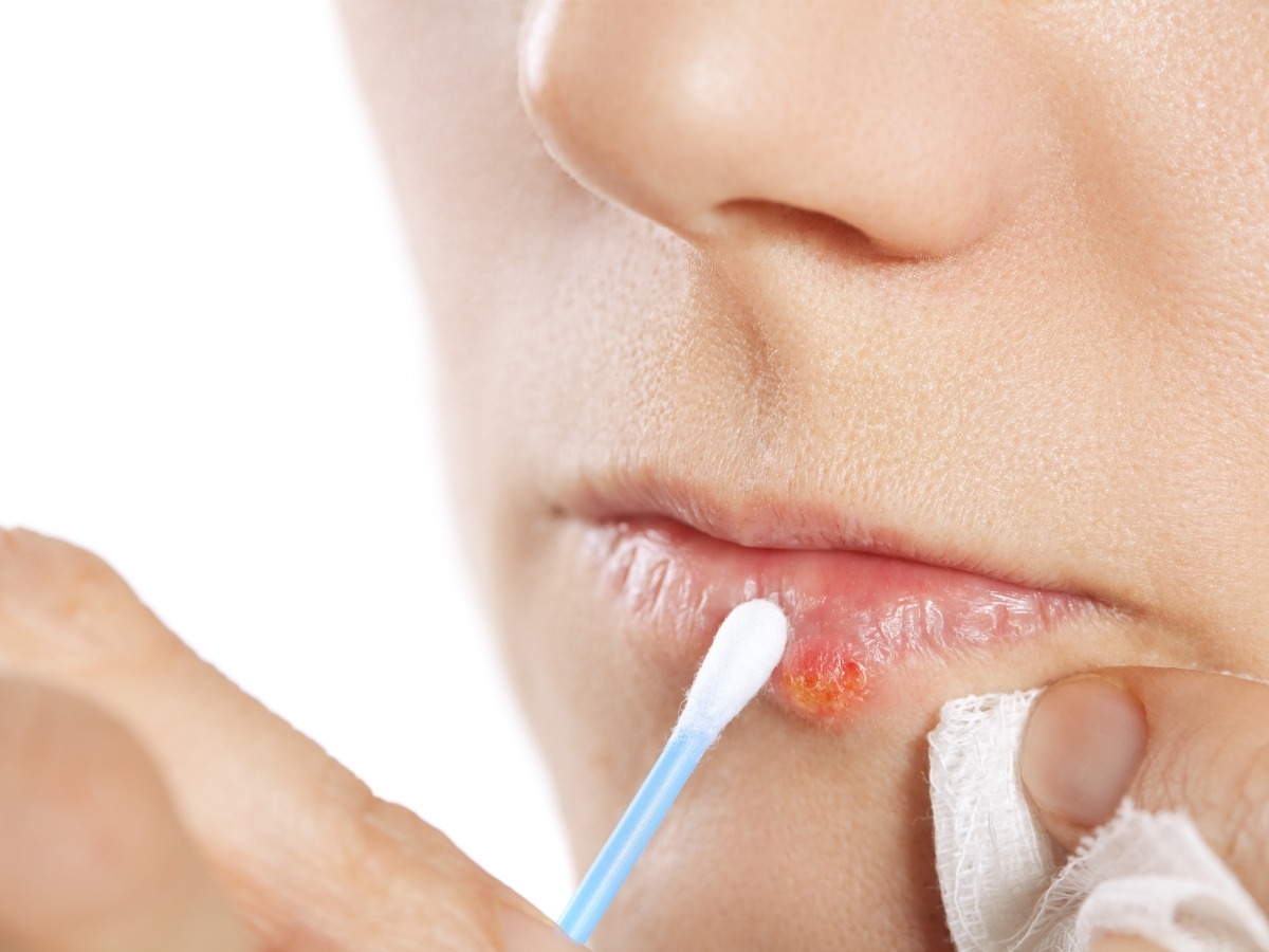 Hướng dẫn xử trí herpes simplex vùng môi (herpes môi) sau xăm hoặc phun: cách nhận biết, phòng ngừa và xử trí dựa trên bằng chứng y khoa 