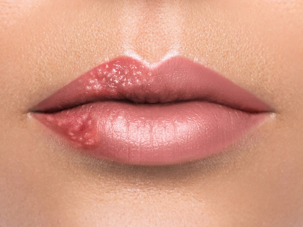 Hướng dẫn xử trí herpes simplex vùng môi (herpes môi) sau xăm hoặc phun: cách nhận biết, phòng ngừa và xử trí dựa trên bằng chứng y khoa 
