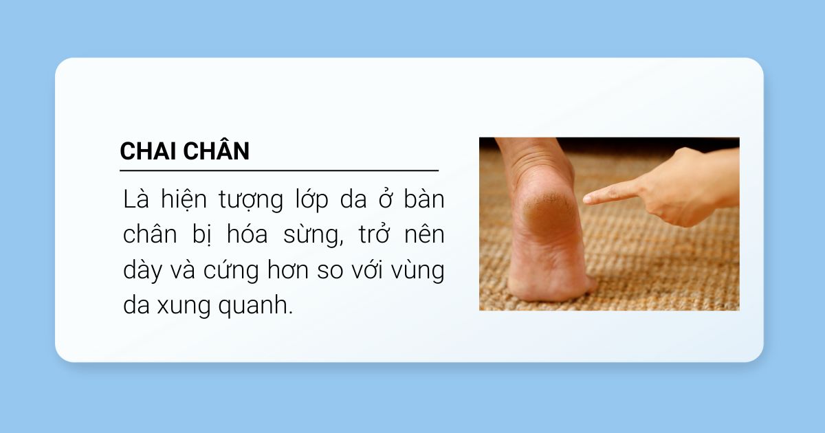 Định nghĩa chai chân là gì 