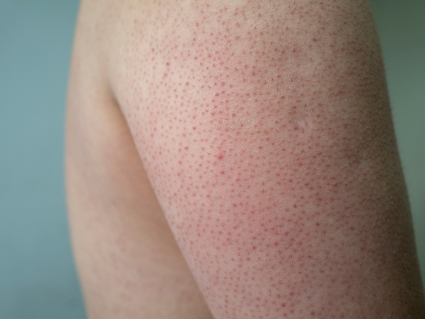 Chứng tăng sừng (da gà) và cách khắc phục