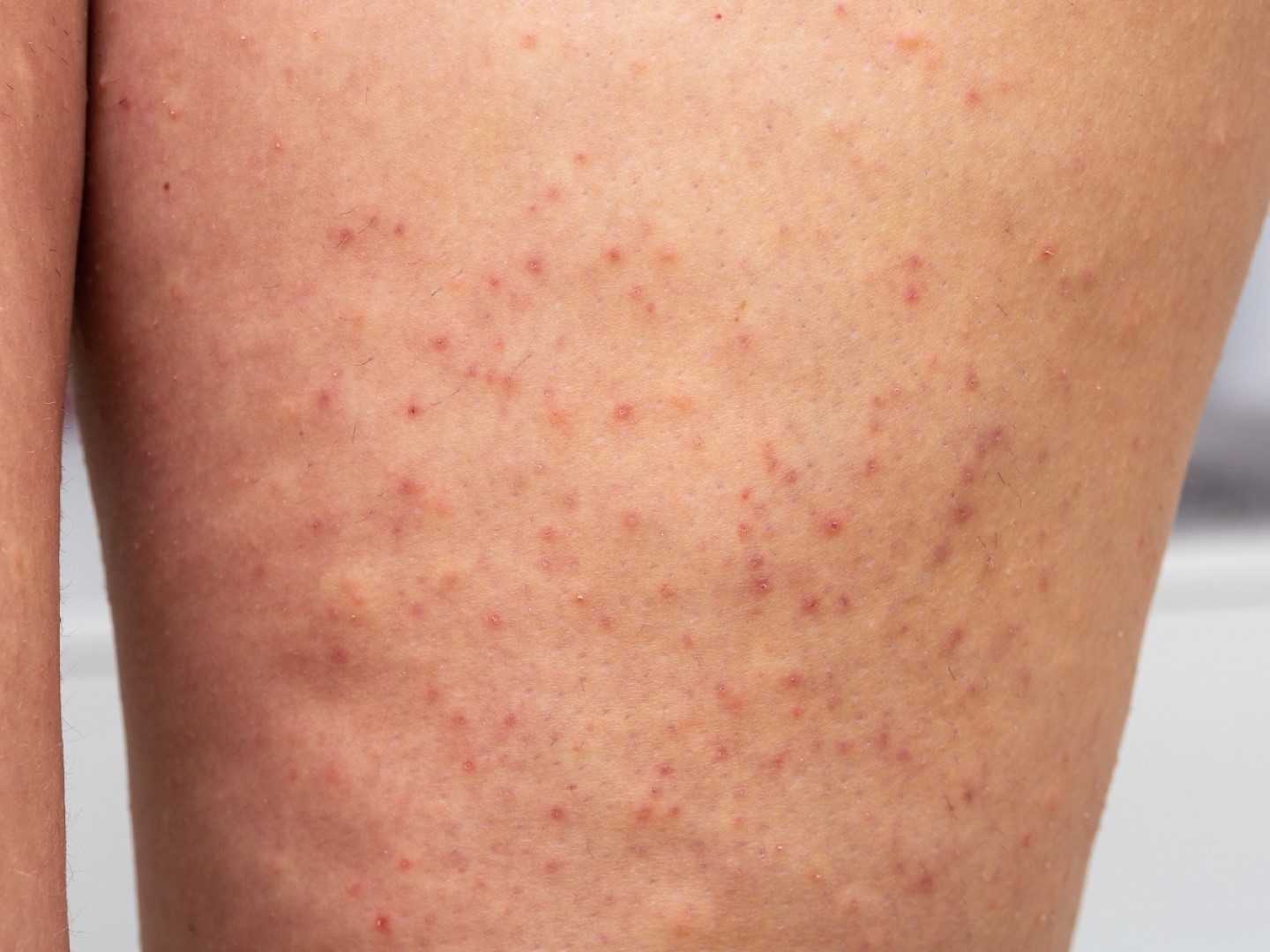 Chứng tăng sừng (da gà) và cách khắc phục