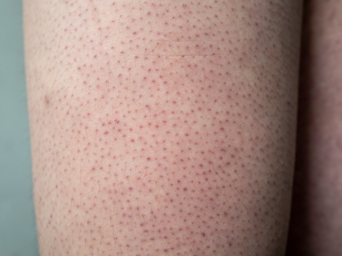 Chứng tăng sừng (da gà) và cách khắc phục