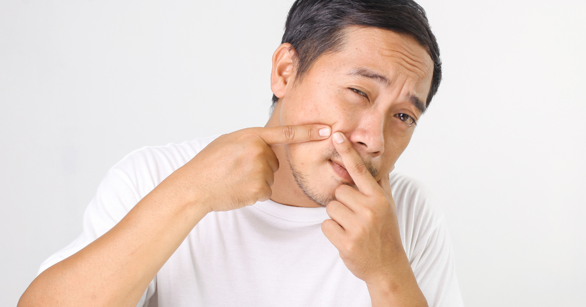 Độ tuổi bị mụn ẩn phổ biến 