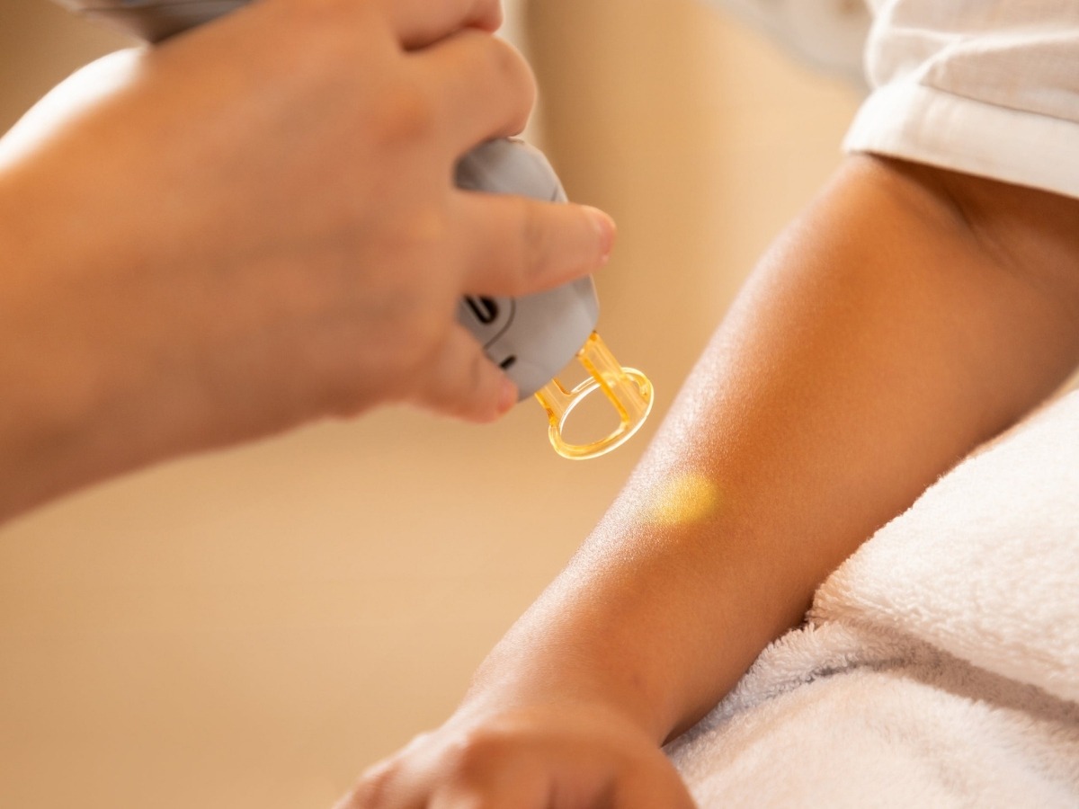 Laser CO₂ Fractional có gây mỏng da không? Hiểu đúng cơ chế để tránh lo lắng