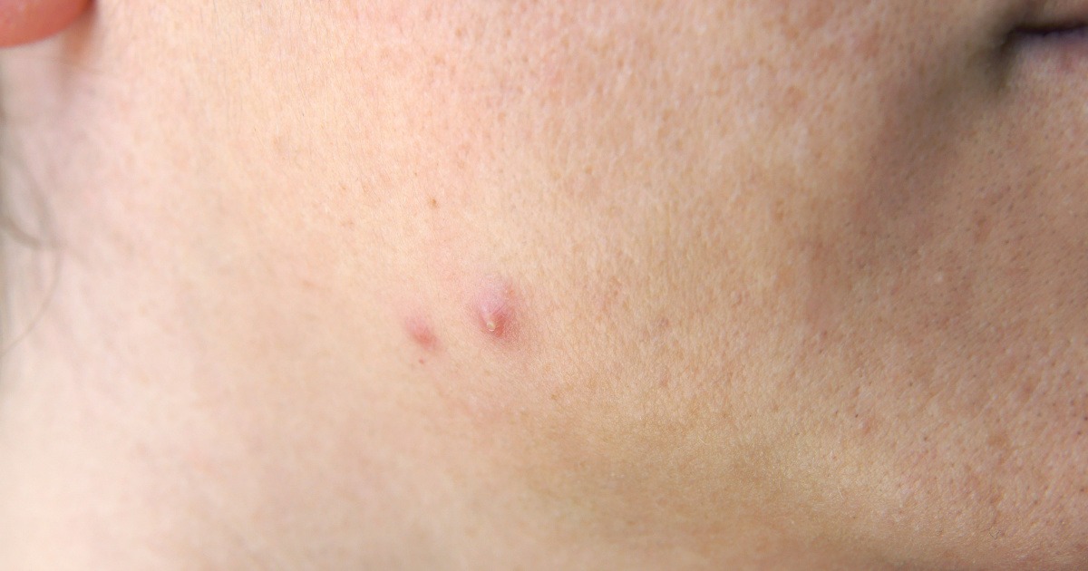 Mụn ẩn có tái phát không