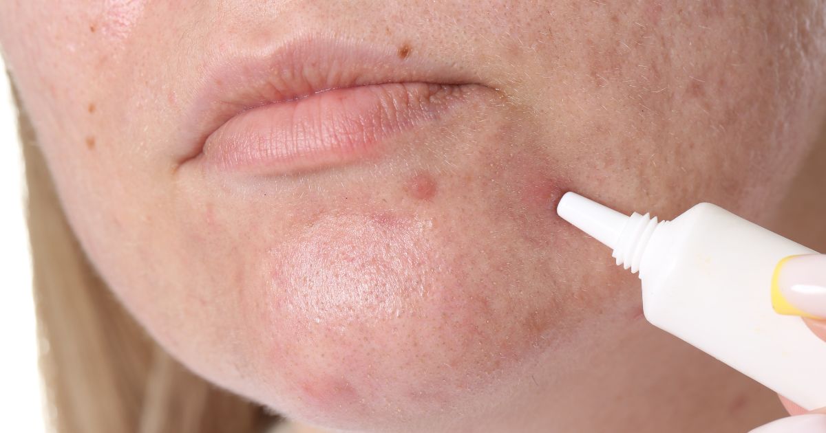 quy trình điều trị mụn 