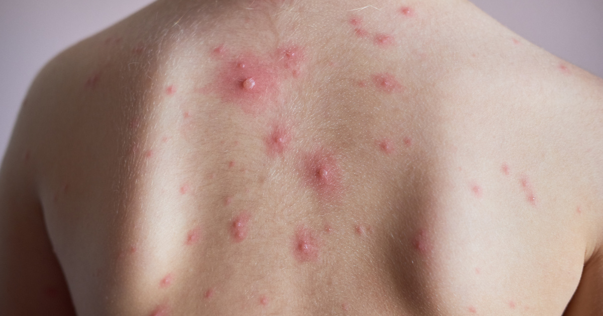 Mụn cứng dưới da có tự khỏi được không?