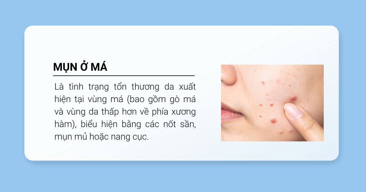 Định nghĩa mụn ở má là gì