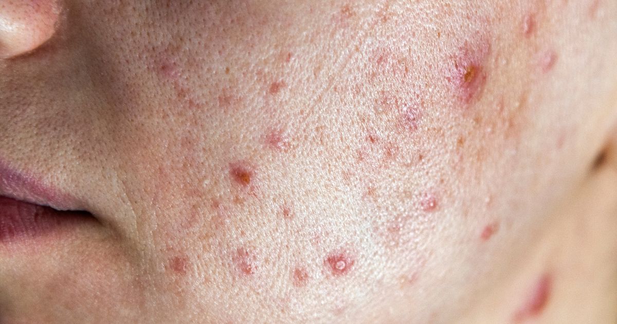 Mụn ở má thường gồm loại nào