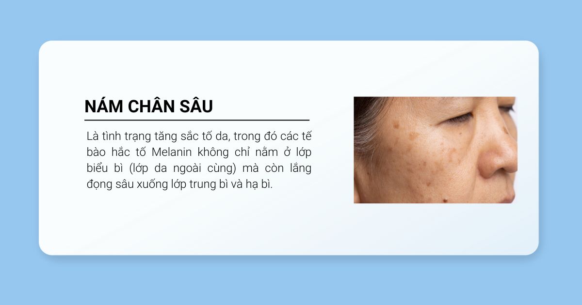 Nám chân sâu định nghĩa 