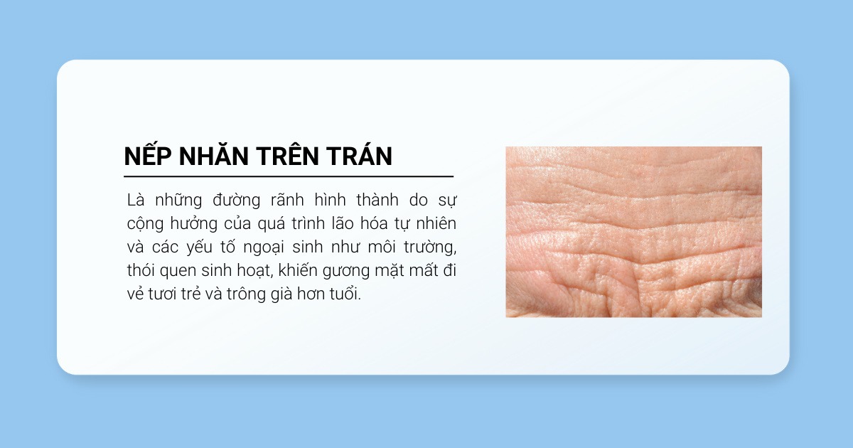 Nếp nhăn trên trán là gì