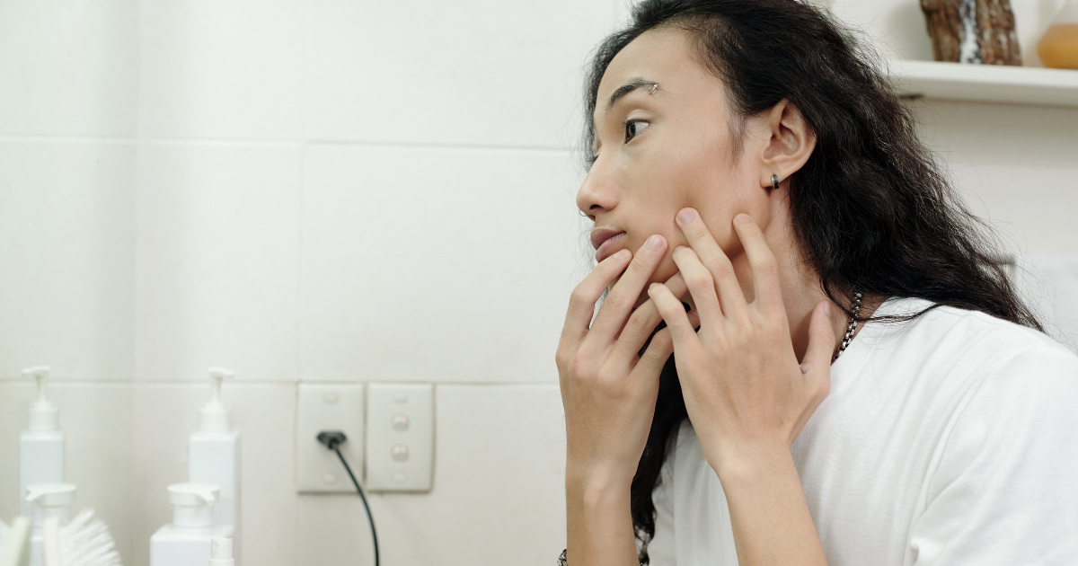 Nguyên nhân gây mụn ẩn ở má