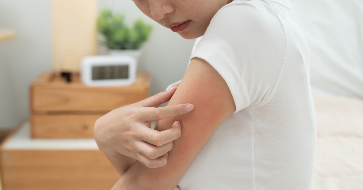 Nguyên nhân nổi mẩn ngứa