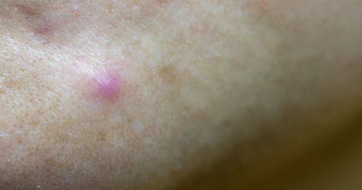 Nguyên nhân hình thành mụn bọc không đầu