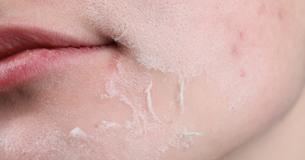 Những sai lầm phổ biến khi peel da