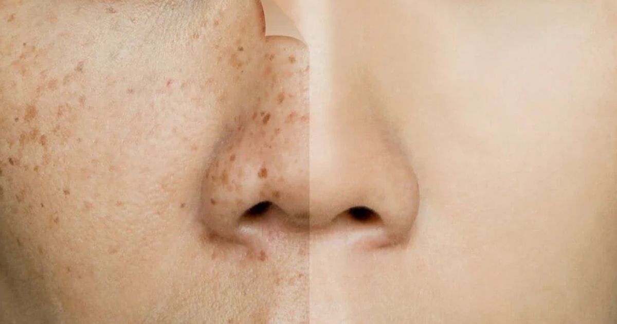 Phân loại rối loạn sắc tố da