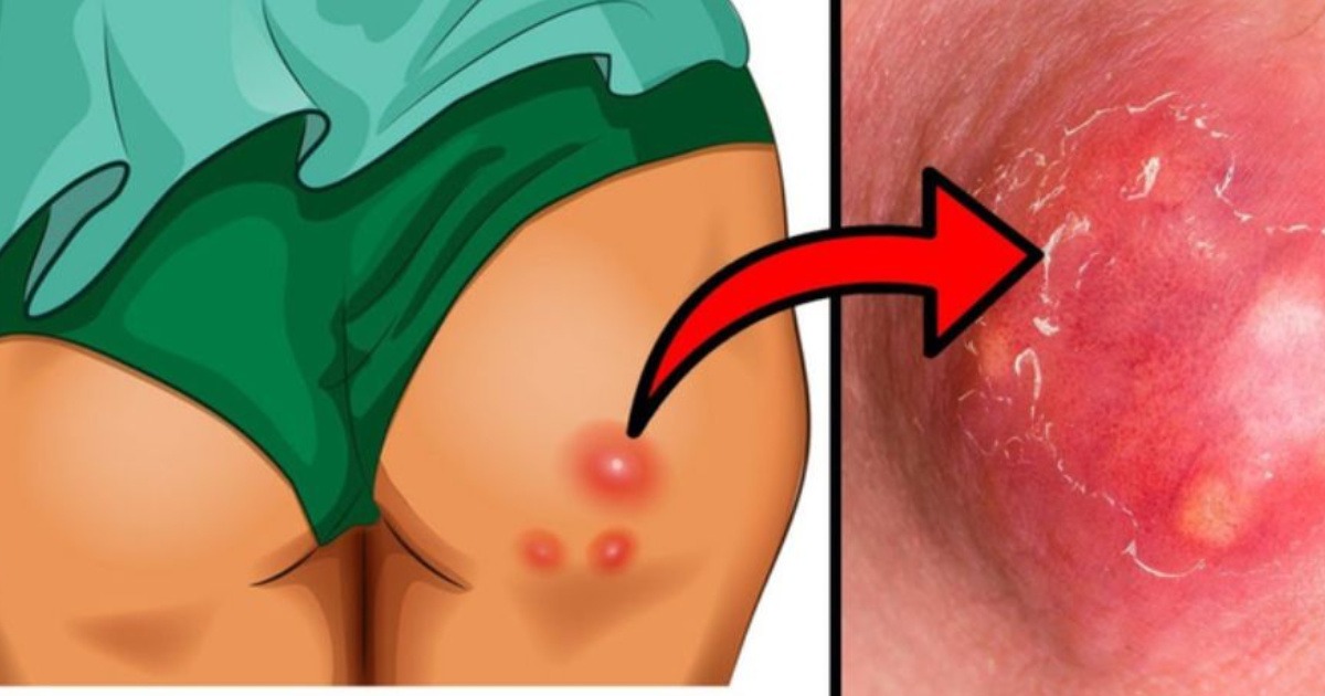 phân loại mụn nhọt ở mông