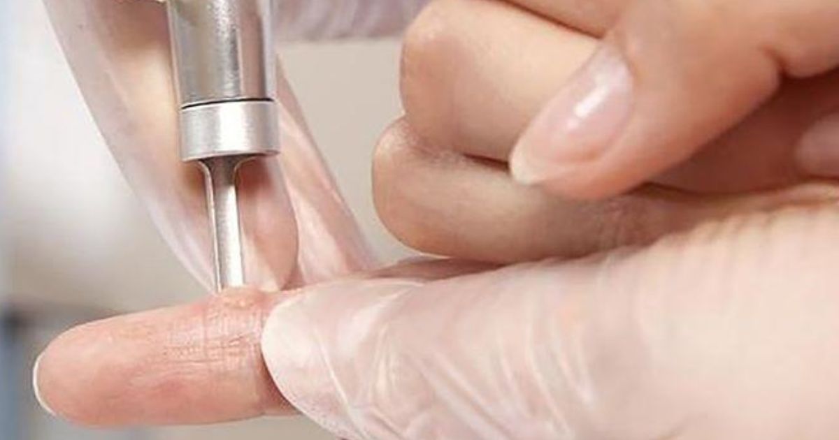 phương pháp điều trị mụn cóc hiệu quả