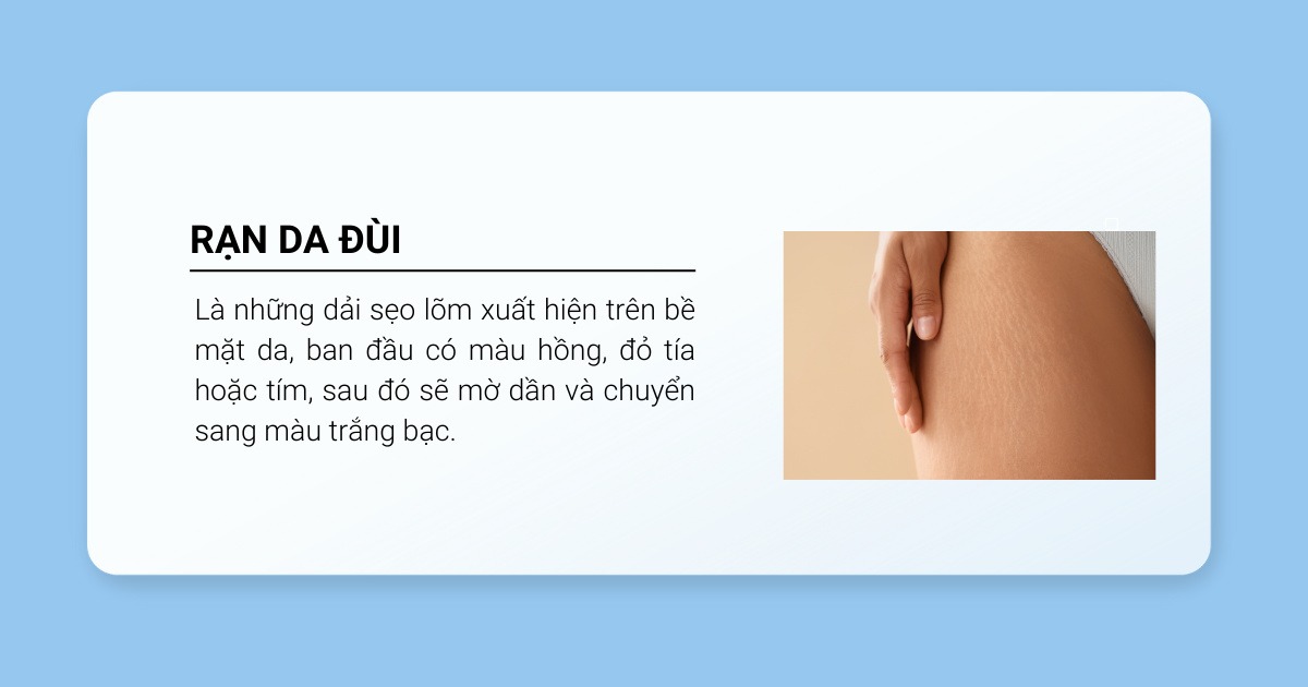 Định nghĩa rạn da đùi 