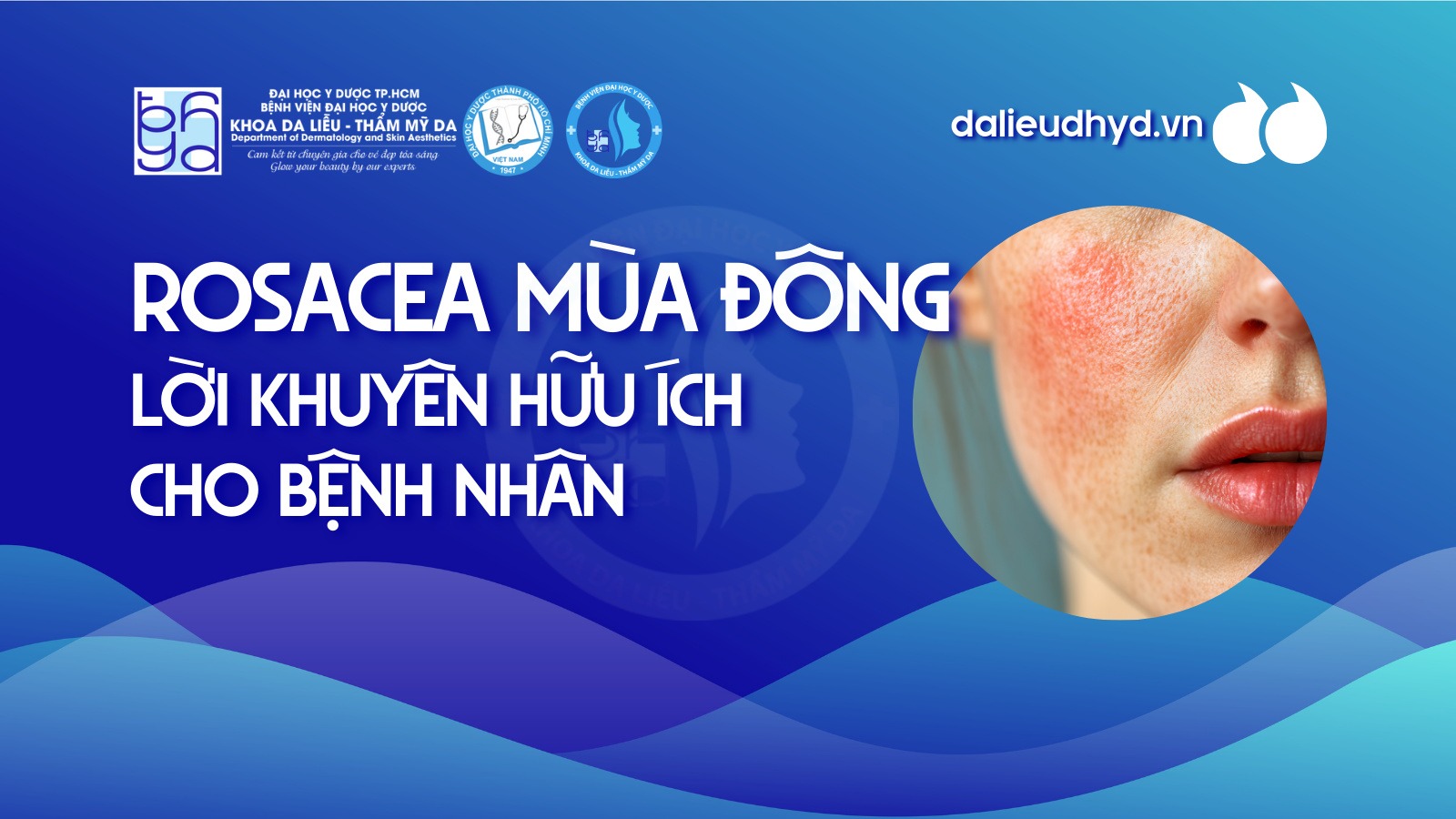 Lời khuyên hữu ích cho bệnh nhân bị bệnh rosacea mùa đông