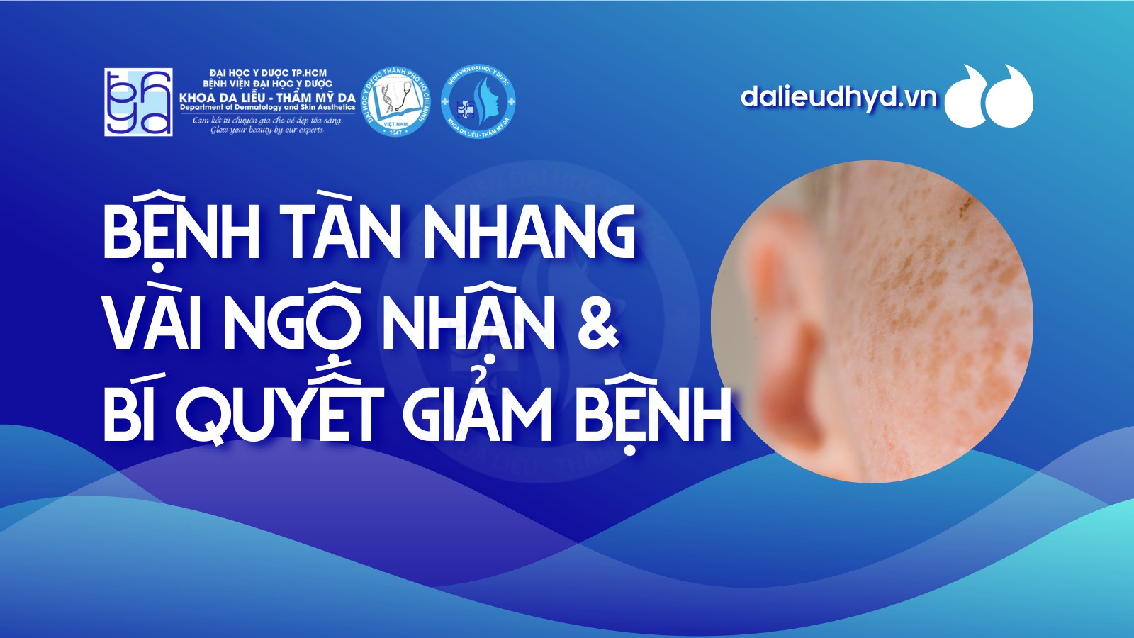 Vài ngộ nhận về tàn nhang và bí quyết giảm bệnh