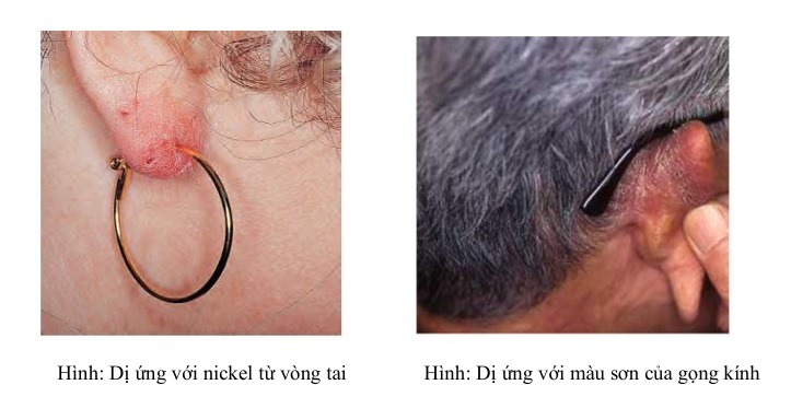 Hình: Dị ứng với nickel từ vòng tai

Hình: Dị ứng với màu sơn 
của gọng kính