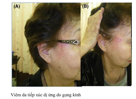Viêm da tiếp xúc dị ứng do gọng kính
