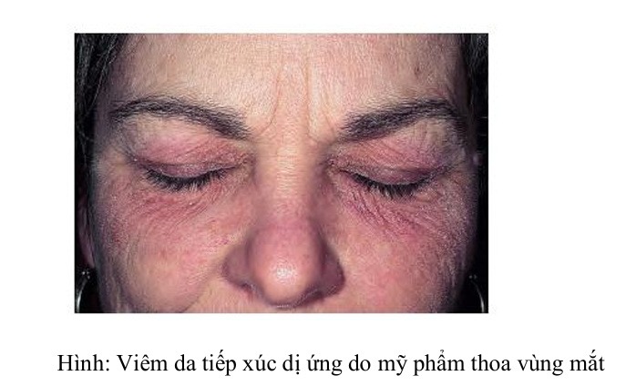 Hình: Viêm da tiếp xúc dị ứng do mỹ phẩm thoa vùng mắt
