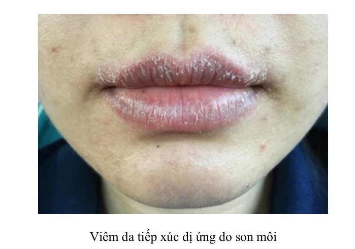 Viêm da tiếp xúc dị ứng do son môi
