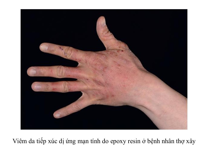 Viêm da tiếp xúc dị ứng mạn tính do epoxy resin ở bệnh nhân thợ xây