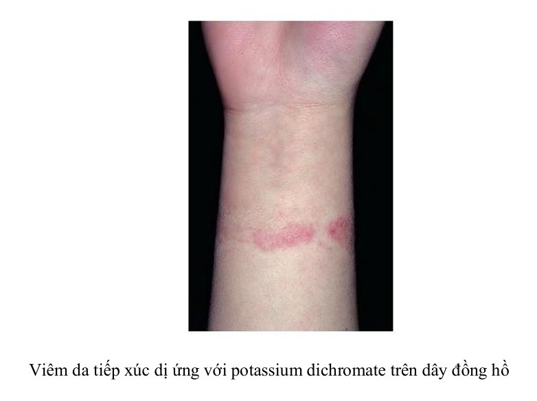 Viêm da tiếp xúc dị ứng với potassium dichromate trên dây đồng hồ
