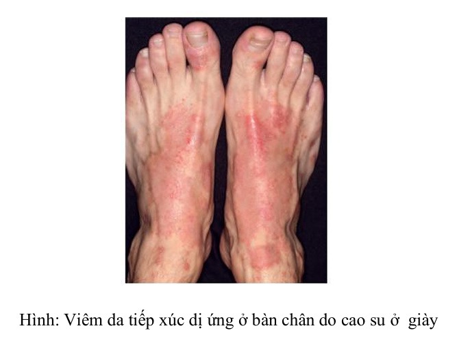 Hình: Viêm da tiếp xúc dị ứng ở bàn chân do cao su ở  giày