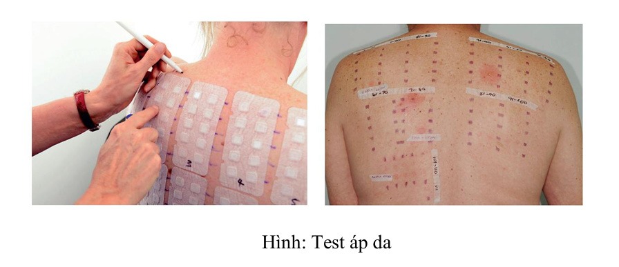 Hình: Test áp da