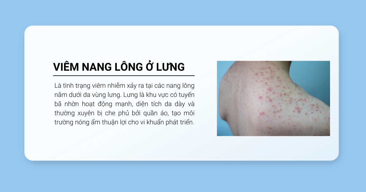 khái niệm viêm nang lông