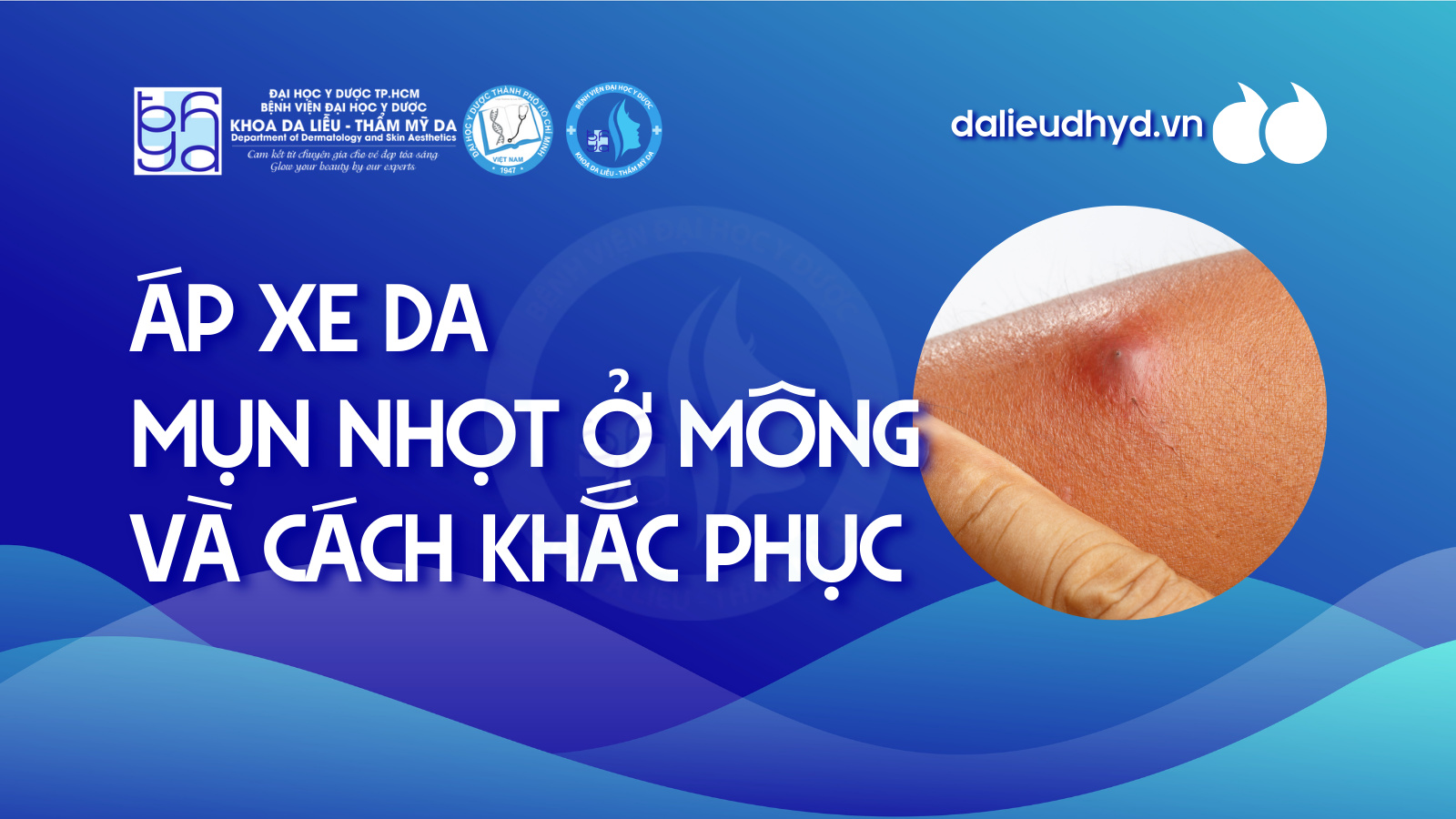 Áp xe da, mụn nhọt ở mông và cách khắc phục