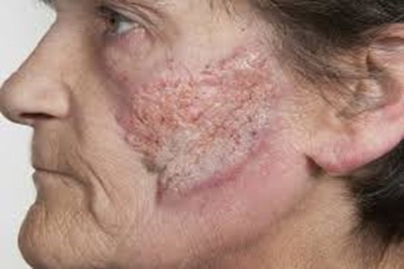 Những người có hệ miễn dịch yếu là nhóm có rủi ro mắc bệnh viêm da mủ dạng sùi cao nhất (Nguồn: Casereports.bmj)