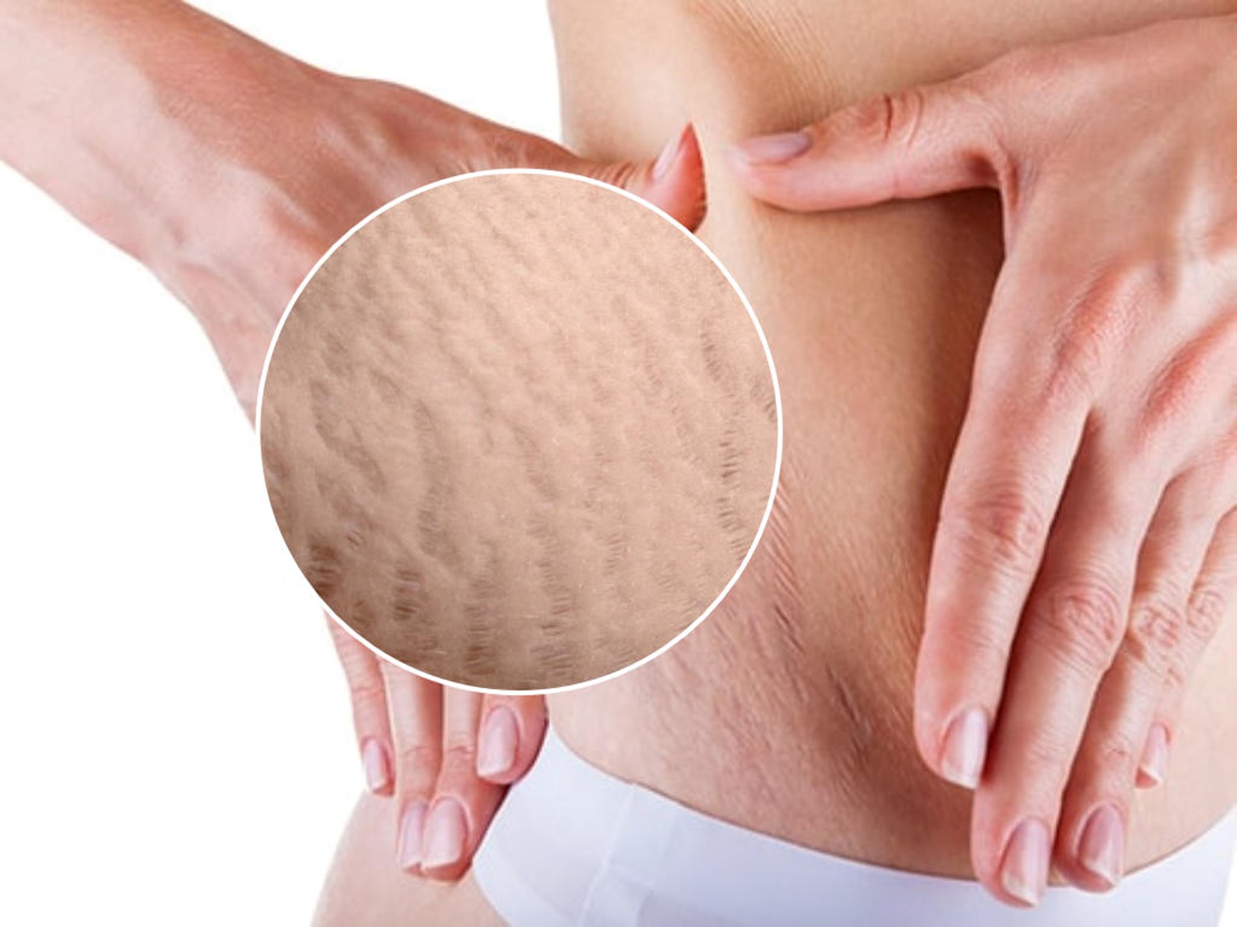 Rạn da là một dạng sẹo xuất hiện sau khi da bị kéo căng hoặc co lại nhanh, nhất là ở phụ nữ (Nguồn: Dermedica.com.au)