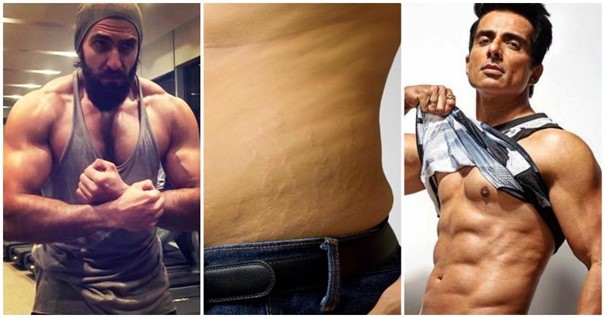 Rạn da ở nam giới khác với phụ nữ, thường do tăng cân đột ngột, di truyền và do lạm dụng các loại thuốc tăng cân (Nguồn: Mensxp).