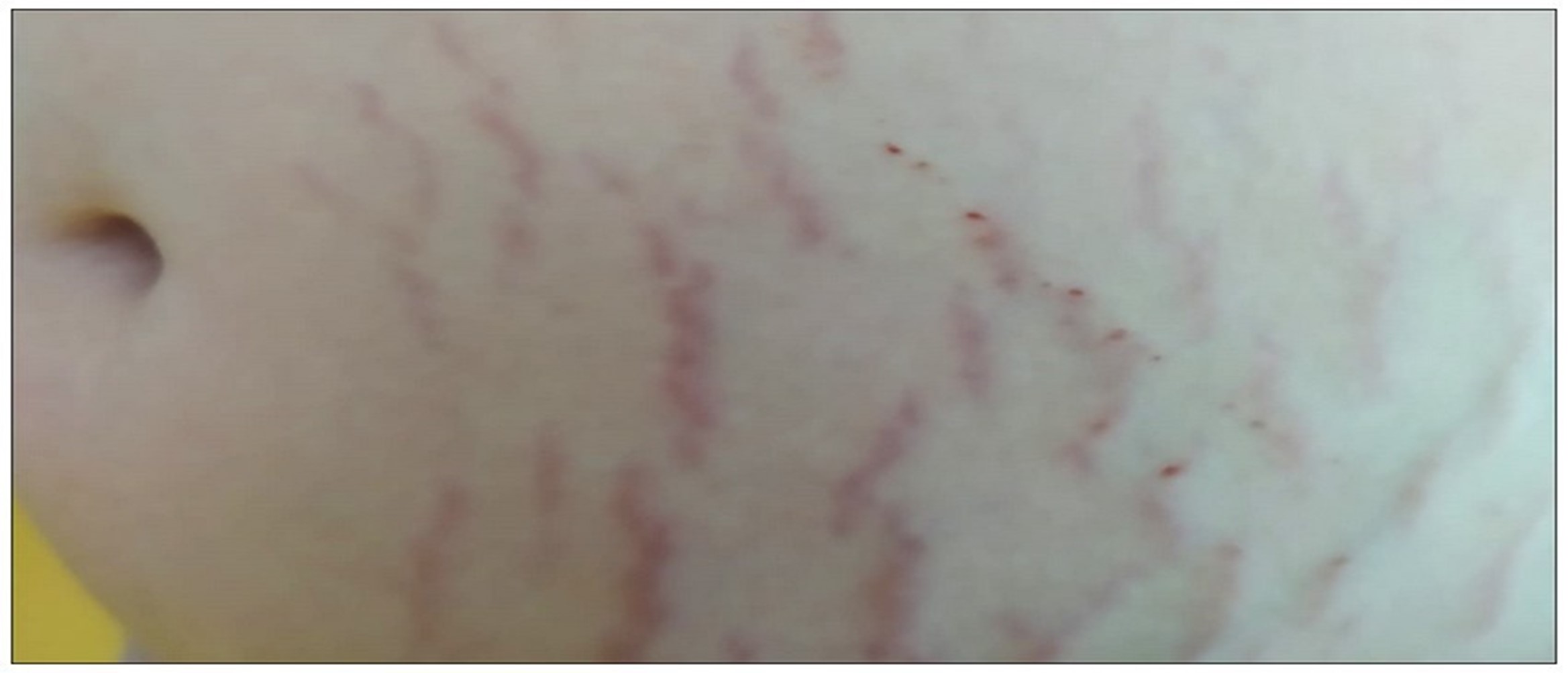 Rạn da ở phụ nữ thường xuất hiện khi mang thai và do béo phì (Nguồn internet)